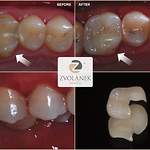 Ceramic and gold fillings – inlays and onlays