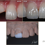 Direct bonding with composite