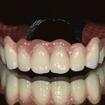 Tooth supported telescopic denture/ bridge