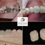 Ceramic and gold fillings – inlays and onlays