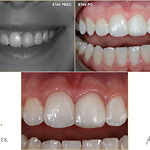 Estetické úpravy zubů kompozitem