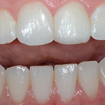 Estetické úpravy zubů kompozitem